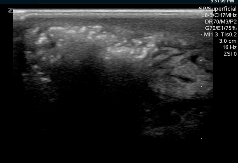 File:Gas gangrene.png