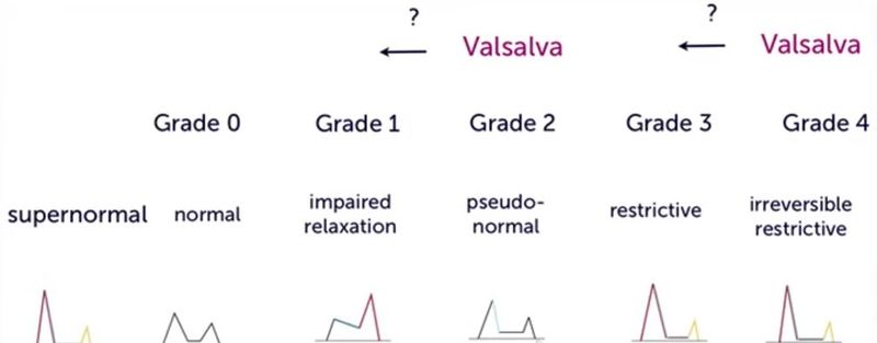 File:Grading diastolic dysfunction.JPG