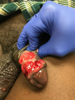 Granuloma Inguinale.JPG