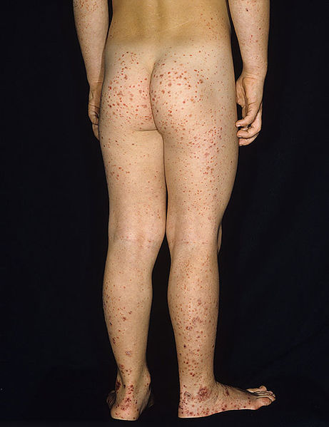File:Henoch-schonlein-purpura.jpg
