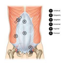Hernia Locations.jpeg