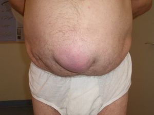 Hernia umilicalis.jpg
