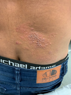 Herpes Zoster.jpg