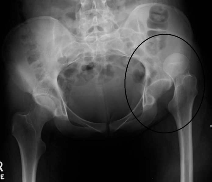 File:HipdisX.png