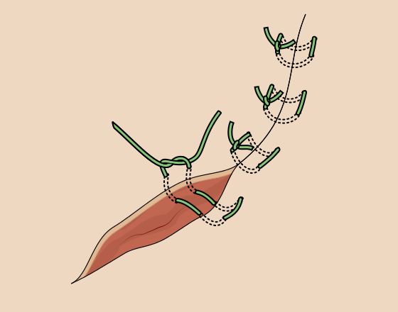 File:Horizontal mattress suture.svg