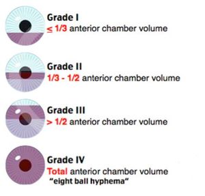 Hyphema grading.JPG