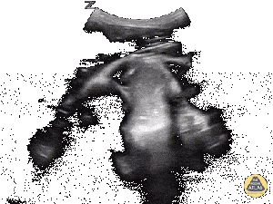 In-Vivo Shoulder Reduction[2]