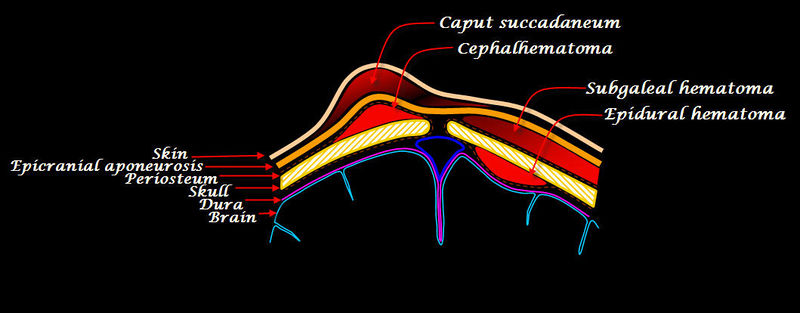 File:InfantScalpHematoma.jpeg