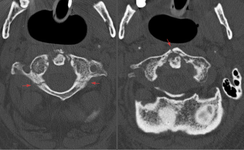 File:Jefferson fracture CT.jpg