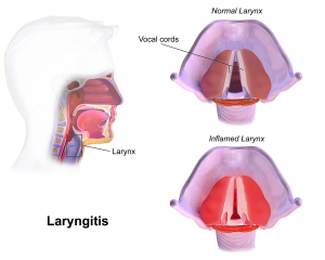 Laryngitis.png