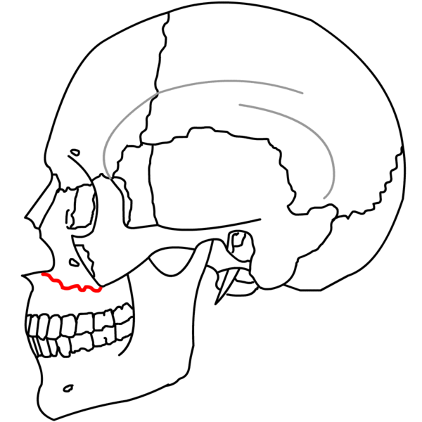 File:LeFort1a.png