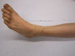 Lightning injury (1).jpg