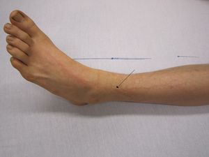Lightning injury (1).jpg
