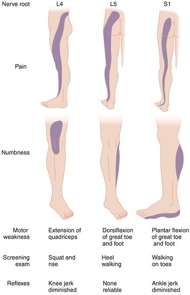 File:Lumbar Nerve Root Compromise.jpg