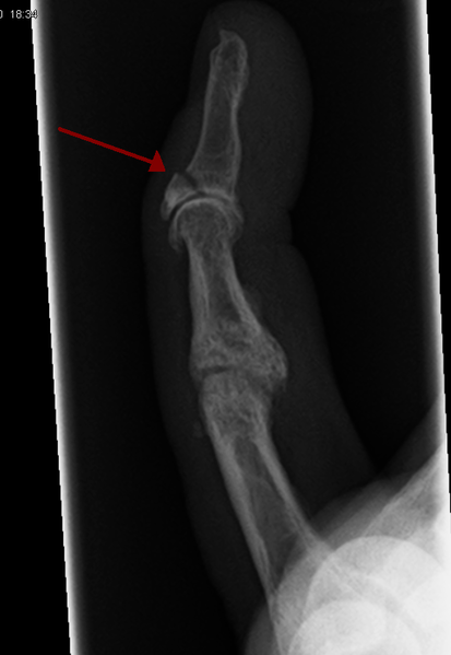File:MalletFinger.png