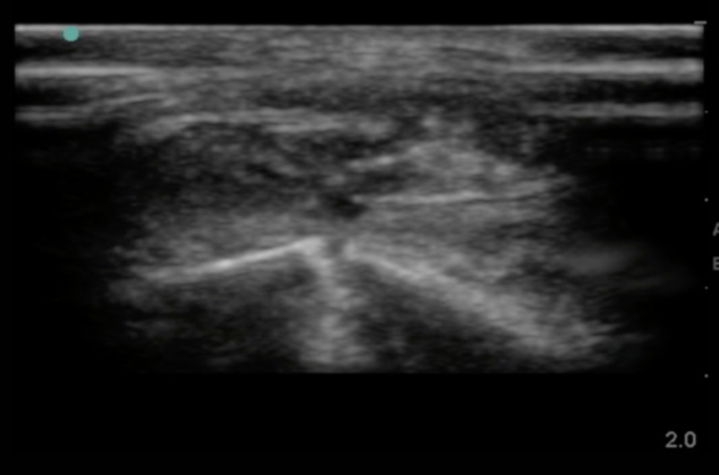 File:Metacarpal fx.png