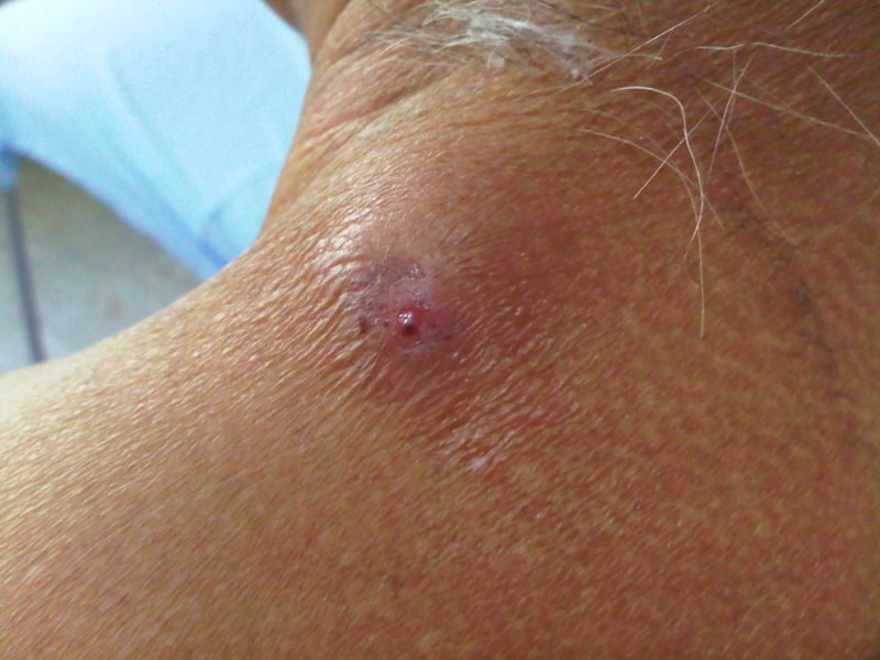 File:Miasis human.jpg