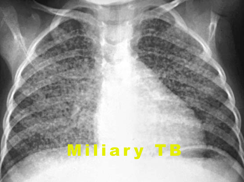 File:MiliaryTB.png