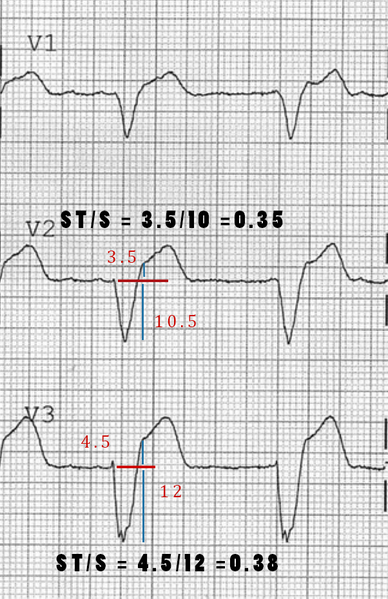 File:Modified-sgarbossa.png