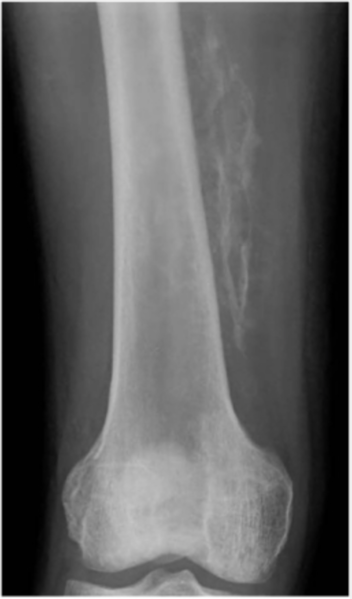 File:MyositisOssificans.png