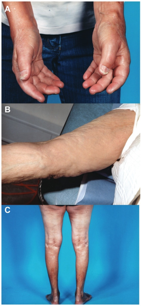 File:NephrogenicSystemicFibrosis.png