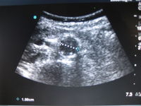 Normal Aorta.JPG