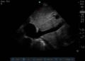 Normal IVC.gif