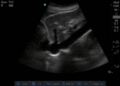 Normal IVC 2.gif