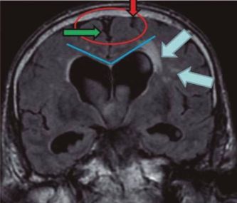 Normal pressure hydrocephalus versus atrophy, CA.jpg