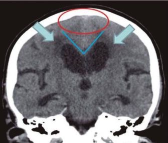 Normal pressure hydrocephalus versus atrophy, NPH.jpg