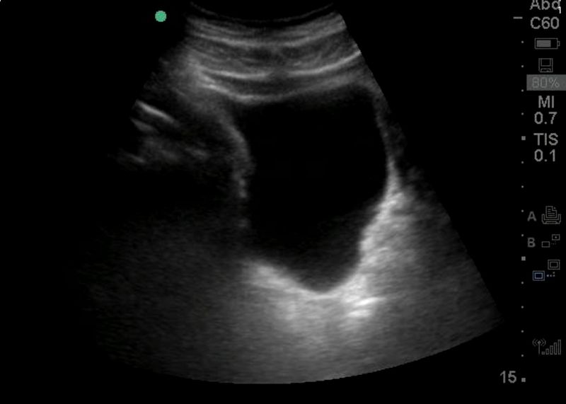 File:Normal sagittal bladder.jpg