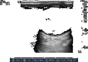 Ocular - Retinal detachment.gif