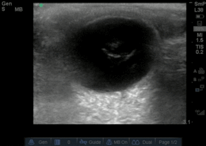Ocular - Vitreous hemorrhage.gif