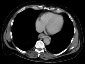 Oesophagusvarizen 02.jpg