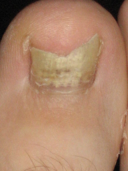 File:Oncyomycosis.jpg