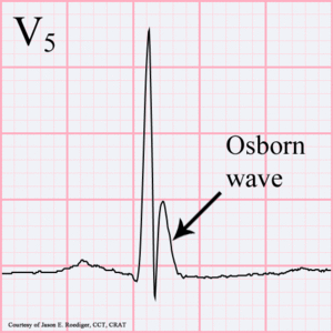 Osborn wave.gif