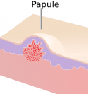 Papule.png