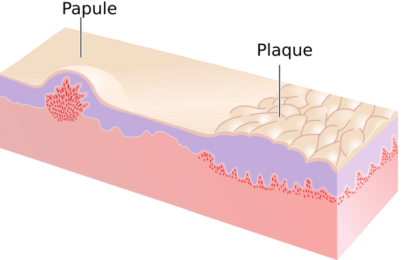 File:Papule and.png