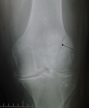 Patella fracture.jpg