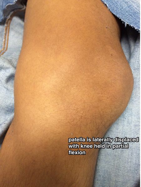 File:Patellar dislocation.jpg