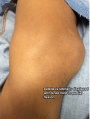Patellar dislocation.jpg