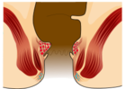 Piles Grade 1.svg