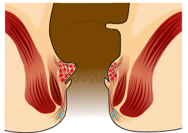 File:Piles Grade 1.svg