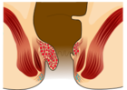 Piles Grade 2.svg