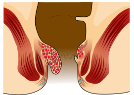 File:Piles Grade 2.svg