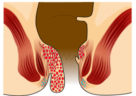 File:Piles Grade 3.svg