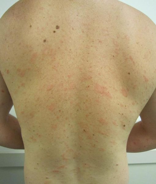 File:Pityriasisrosa.jpg