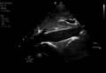 Plethoric IVC.gif