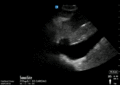 Plethoric IVC 2.gif