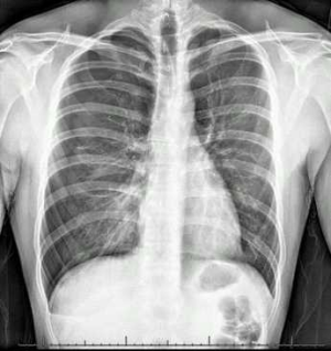 Pneumothorax.png